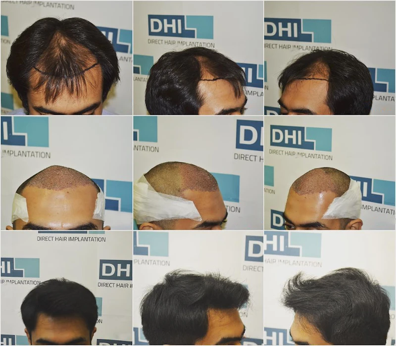 Direct Hair TransplantimplantDHTDH  Dr Atodarias Smart Clinic