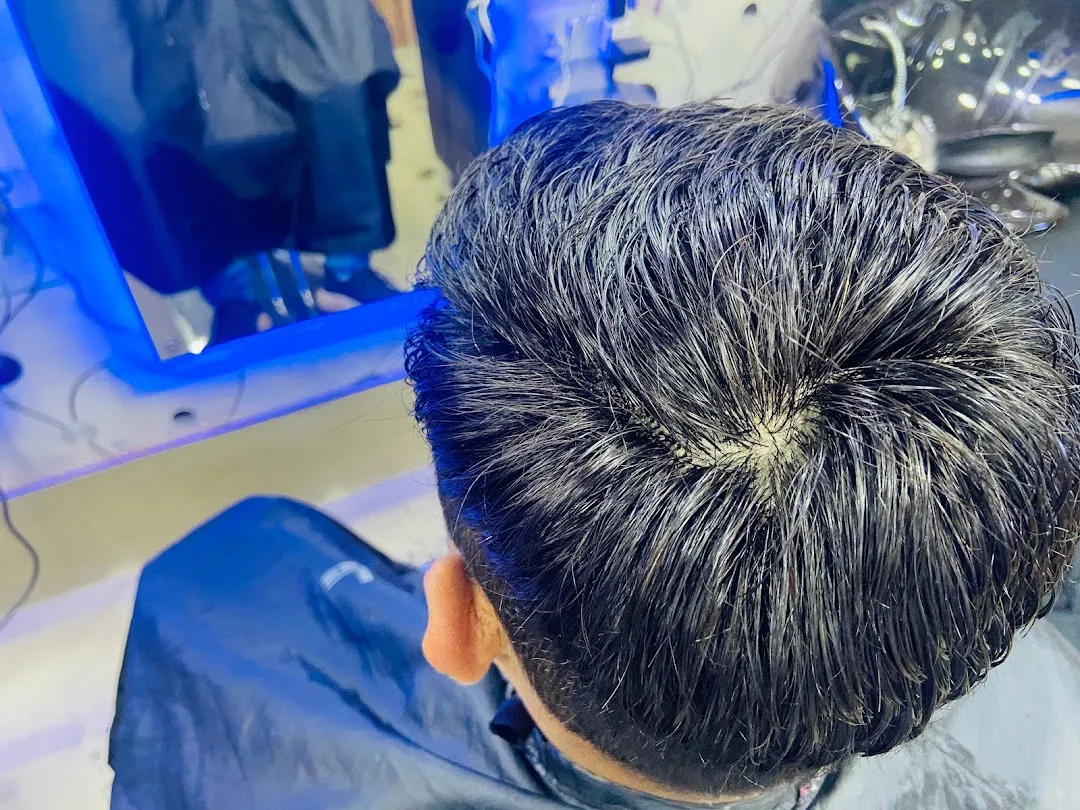 1 Best Hair Loss Treatment for males in Durgapur
