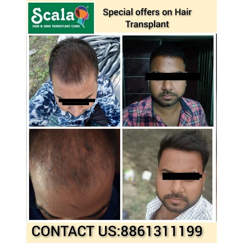 Scala Skin  Hair Transplantation Clinic  Bark Profile