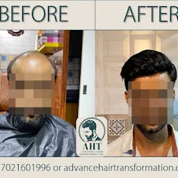 Advance Hair Transformation | Hair Patch for Men | Hair Wig for Men | Hair Treatment for Men