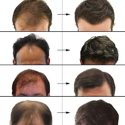 Asian Hair Transplant