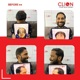 Clion Care - Hair Transplant in Ahmedabad
