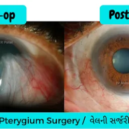 Cornea Centre - Dr. Mehul R Patel's super speciality eye hospital- cornea specialist - eye clinic - Ambawadi -Ahmedabad