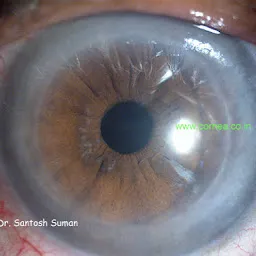 Cornea Eye Hospital- Best Eye Hospital/ Cornea transplant / Keratoconus /