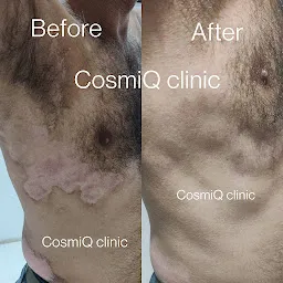 CosmiQ Clinic (best Laser hair reduction in agra| Best hair loss treatment in agra| best skin care treatment in agra)