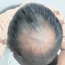 Cosmo Experts Clinic Gwalior - Best Hair Transplant Clinic