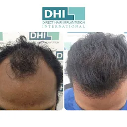 DHI India - Best Hair Transplant Clinic in Delhi