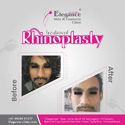 Dr. Ritesh Patel | Breast Reduction & Implants | Liposuction | Hair Transplant | Gynecomastia | Plastic Surgeon In Ahmedabad