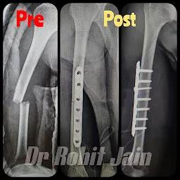 Dr Rohit Jain | ILISHA CLINIC | Orthopedics (Gold medalist) Fracture & Arthritis | Joint Replacement & Arthroscopy Surgeon