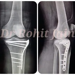 Dr Rohit Jain | ILISHA CLINIC | Orthopedics (Gold medalist) Fracture & Arthritis | Joint Replacement & Arthroscopy Surgeon