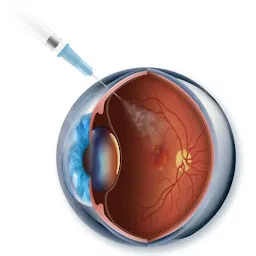 Dr. Sachin Bodhale Netra Eye Clinic Retina laser centre