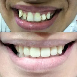 Dr. Tooth Advanced Dental Care & Implant Center | Pediatric dentist best dental clinic in pune | smile design | aligners