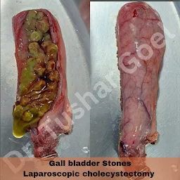 Dr Tushar Goel | Best laparoscopic surgeon | gallbladder | Laparoscopic hernia | bariatric | laser piles | Starmed Hospital