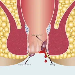 Dr. Veena Bhanushali : Best Laser Surgeon For Piles & Fissure & Fistula in Thane | Proctologist | Anorectal & General Surgeon