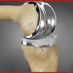 Dr. Tanveer Bhutani | Robotics Knee Replacement treatment & Hip Replacement in Ludhiana, Punjab | Arthroscopy Specialist