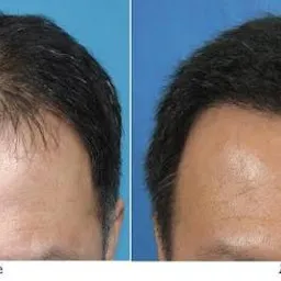 Hair transplantation @ B16 clinic