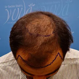 Hair Transplant in Vadodara | Hair Loss Treatment | Hair Growth | Hair Specialist in Vadodara
