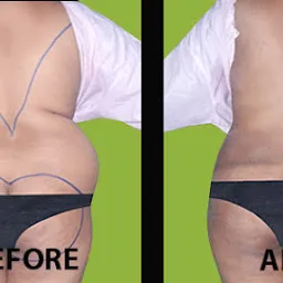 Medini Cosmetic Surgery Centre - Liposuction And Gynecomastia Centre