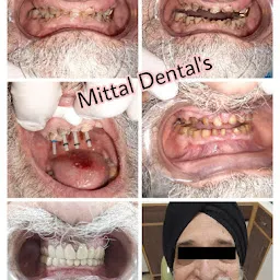 MITTAL DENTAL CARE AND IMPLANT CENTRE | Best Dental Clinic In Mohali