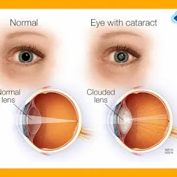 Neu - Vision Superspeciality Brain and Eye Clinic