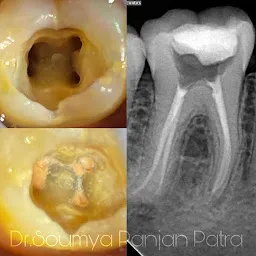 PATRA DENTAL CLINIC ,Advanced Root Canal and Implant Centre