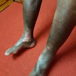 Sarada clinic ( LASER VARICOSE VEIN CENTRE, KERALA)