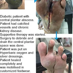 SAVE LEGS DIABETIC FOOT CLINIC - PODIATRIST HYDERABAD INDIA