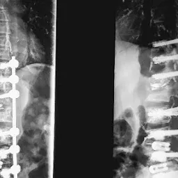 Spine surgery Vellore Dr.Ashok Kumar