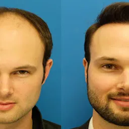 True Hair Transplant