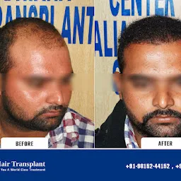 Walia Hair Transplant